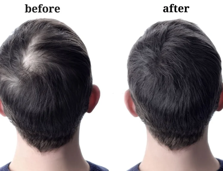 how to stop hair fall naturally and regrow hair fast