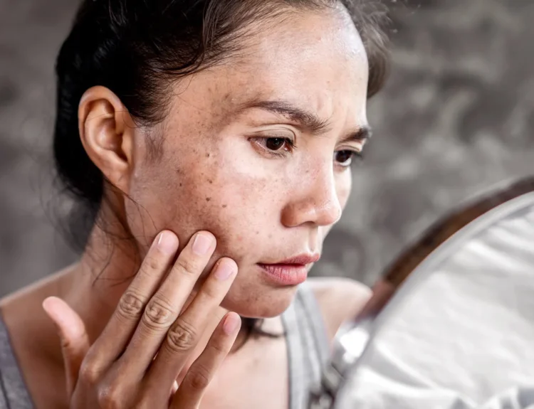 how to remove dark spots from face naturally fast