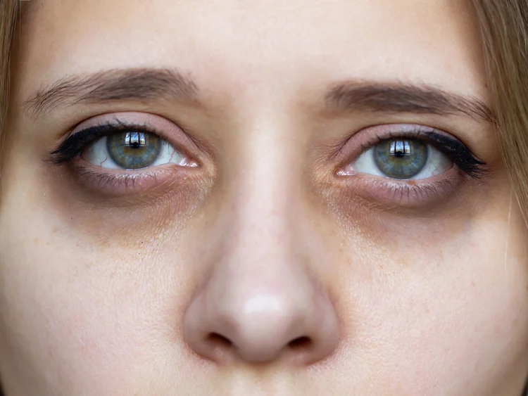 natural remedies for dark circles under eyes fast results