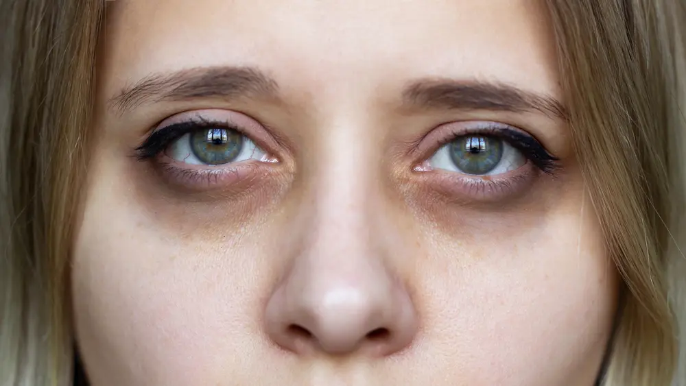 natural remedies for dark circles under eyes fast results