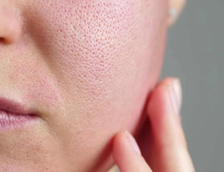 how to reduce the appearance of enlarged pores naturally